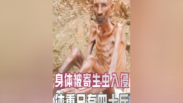 男人的身体里爬满了寄生虫,体重不到四十斤