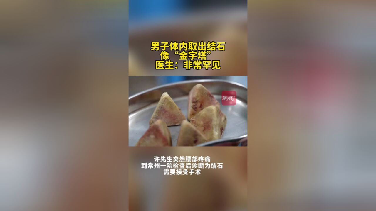 罕见!男子体内取出金字塔状结石