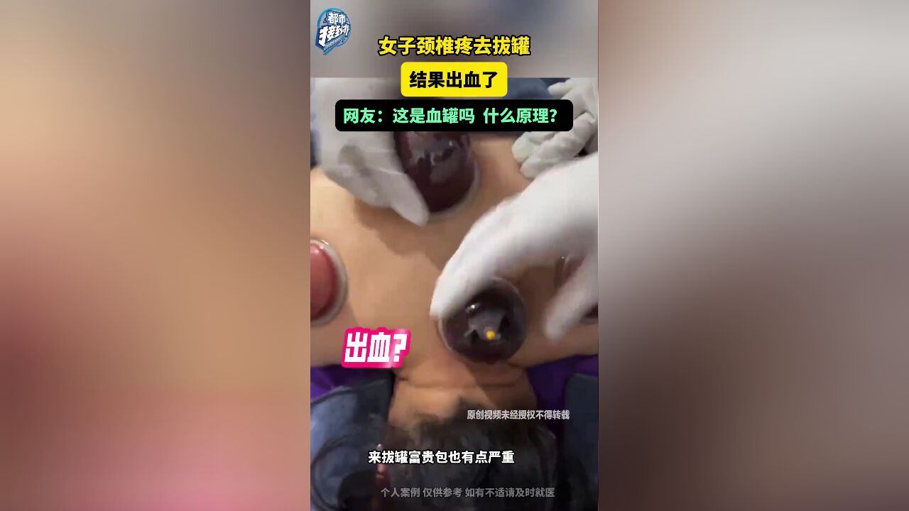 女子颈椎疼去拔罐 结果出血了 网友:这是血罐吗 什么原理?