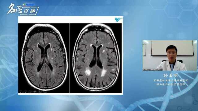 《名医大讲堂》447期 孙玉明 常见脑血管病的诊治科普