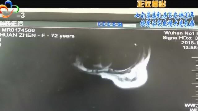 七旬婆婆乳房长包块30年没在意,一次按摩后胸部突然变硬变大