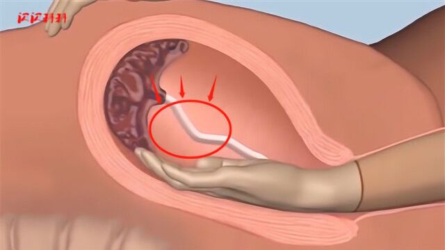 产后手剥胎盘到底有多疼?镜头记录剥盘全过程,看完让人瑟瑟发抖