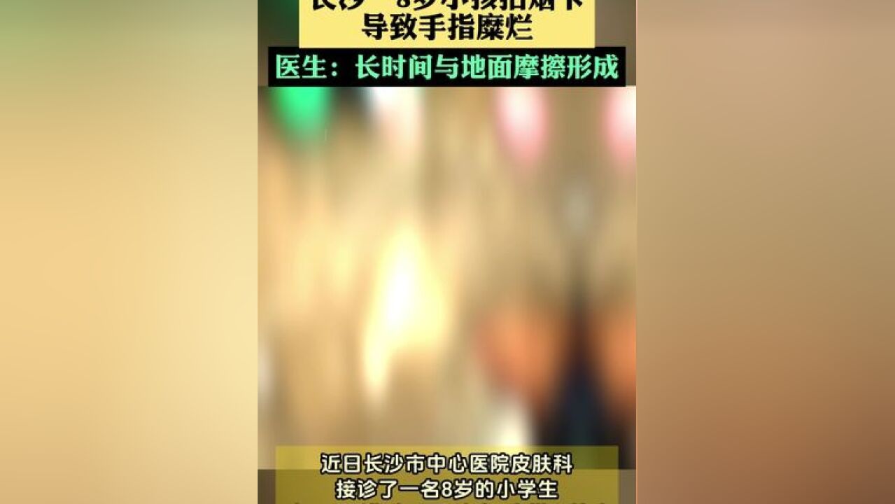 长沙一8岁小孩拍烟卡 导致手指糜烂