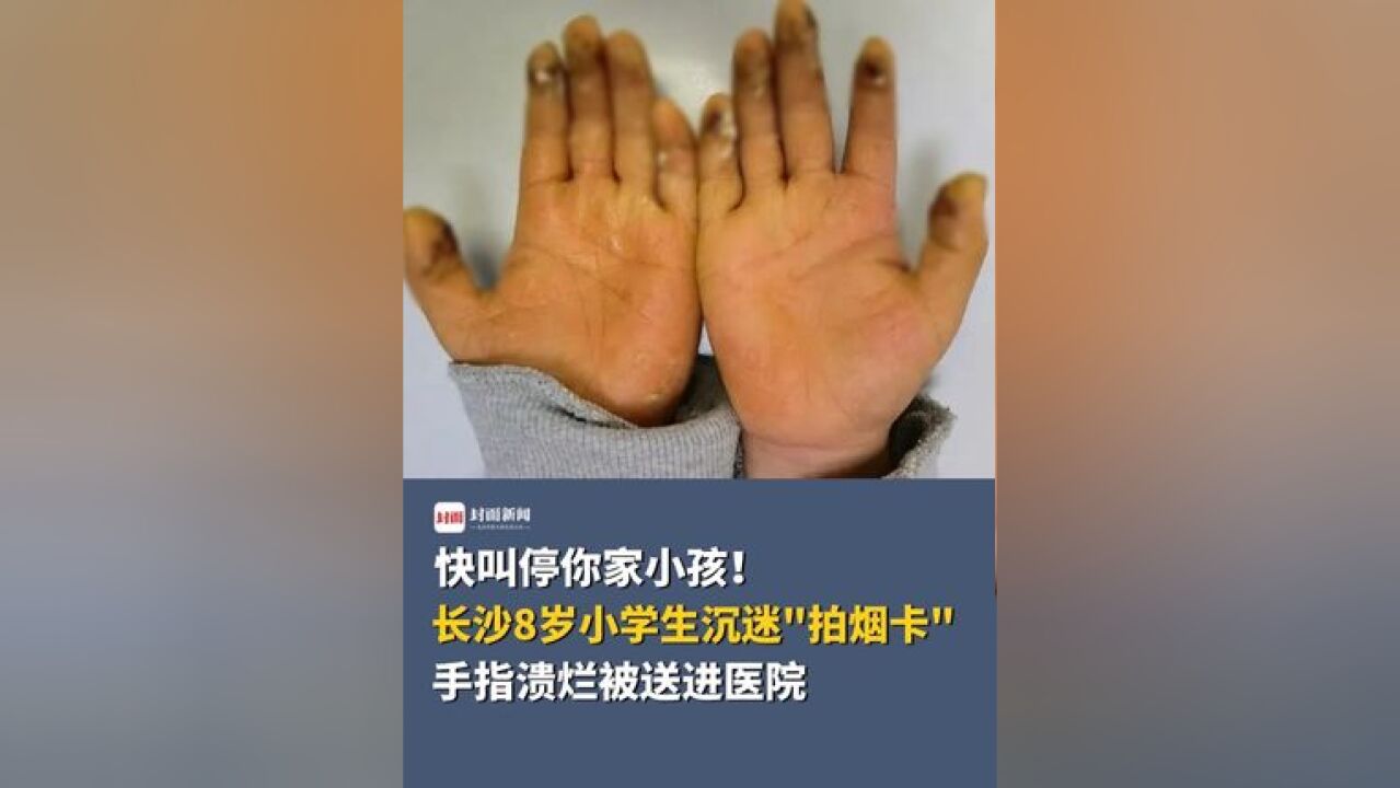 快叫停你家小孩!长沙8岁小学生沉迷“拍烟卡”,手指溃烂被送进医院