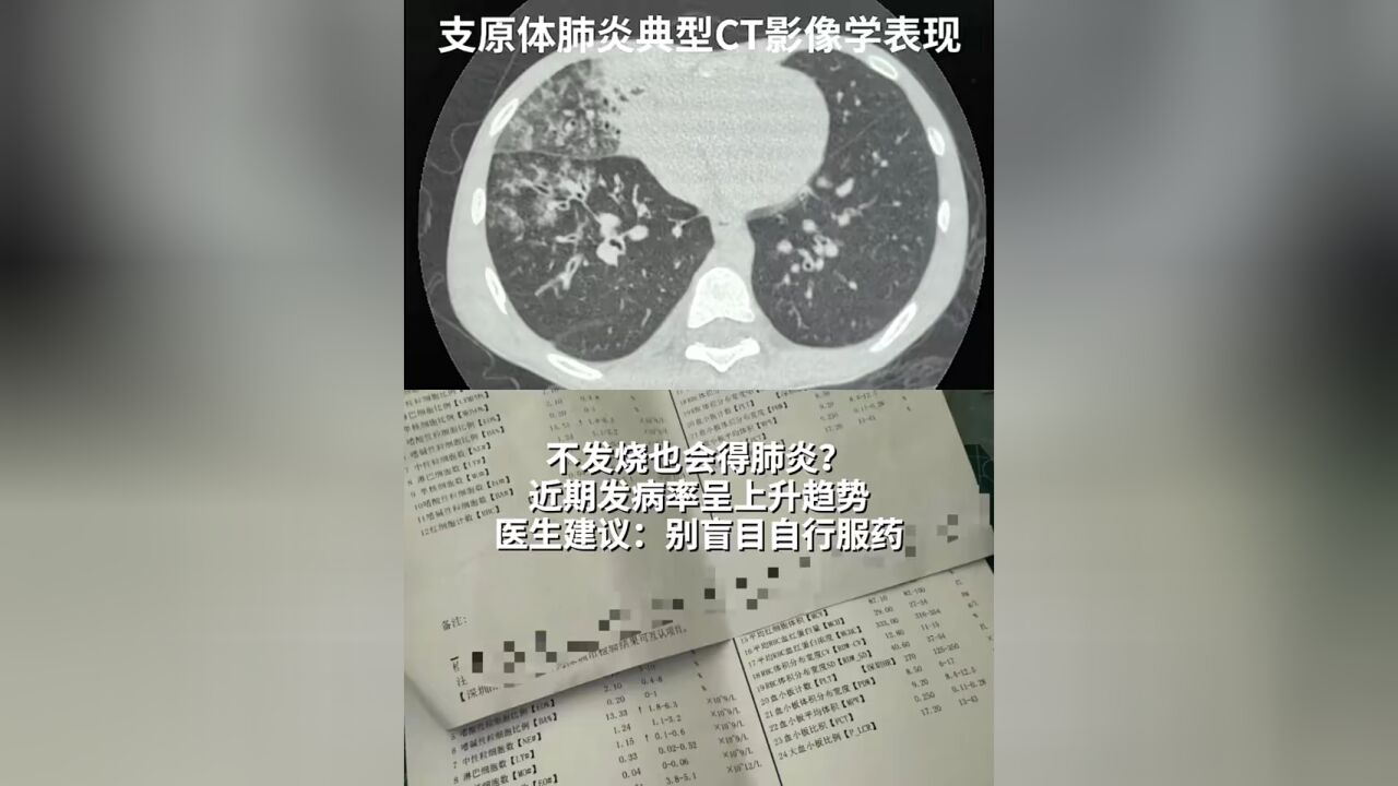 不发烧也会得肺炎?近期发病率呈上升趋势,医生建议:别盲目自行服药