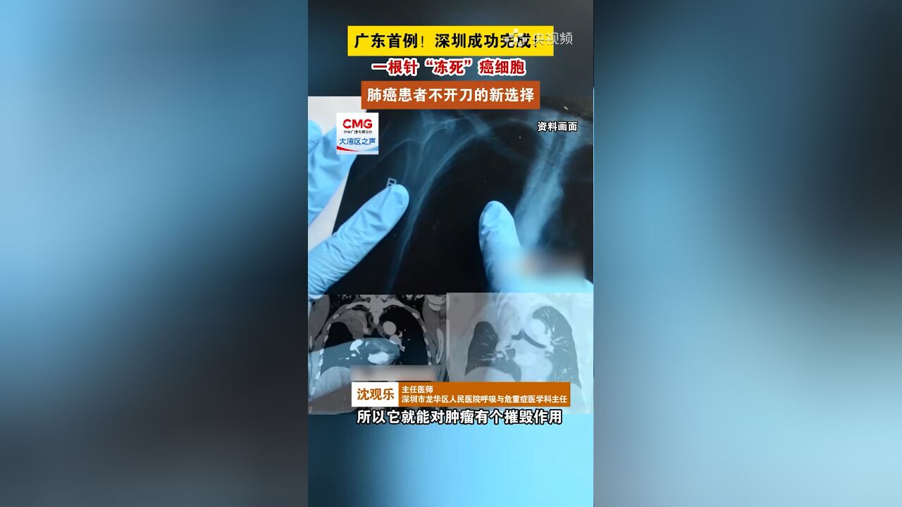 一根针“冻死”癌细胞!深圳成功完成首例