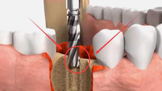 一颗种植牙一万块钱,看完种植体的生产过程,才知值不值