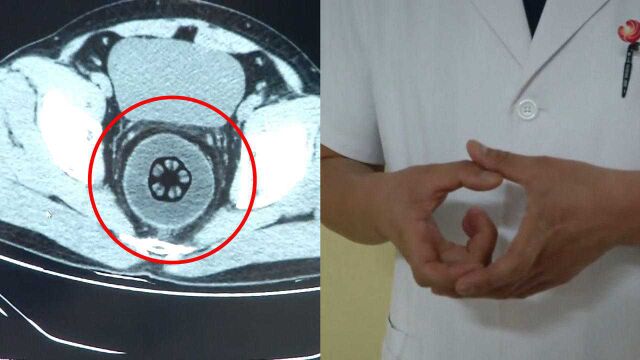 大写的尴尬!小伙为求刺激直肠内塞入异物,医生取出一看都惊了