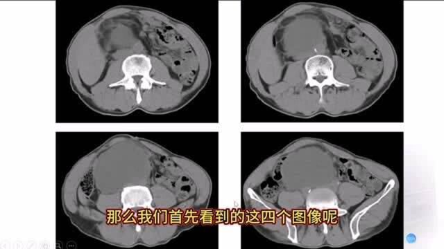 50岁男性,发现腹膜后占位,CT诊断什么?听听放射科医生讲解