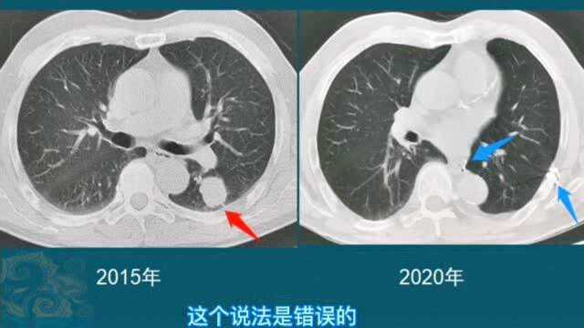 肺癌能治好吗?医生说这3种都能手术,第3种不会复发和转移