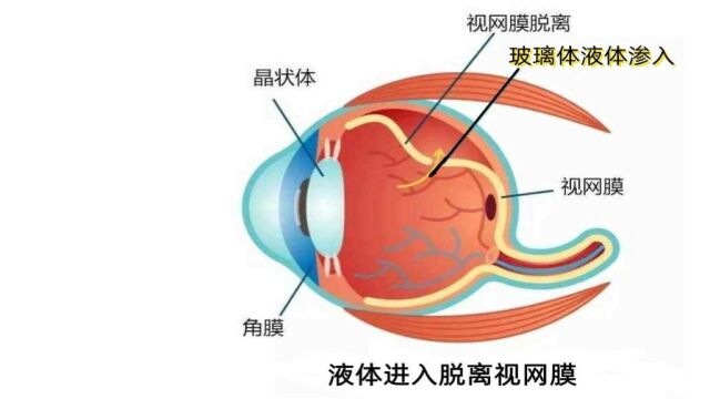 普通话版视网膜脱离术前教育