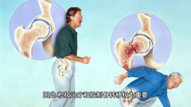 乳腺癌骨转移的扛把子:双膦酸盐VS地舒单抗