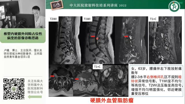 椎管内硬膜外间隙病变影像诊断思路中大卢瞳