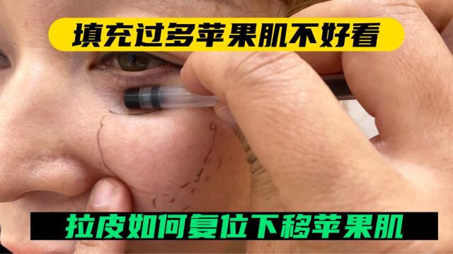 填充过多苹果肌不好看,拉皮如何复位下移苹果肌