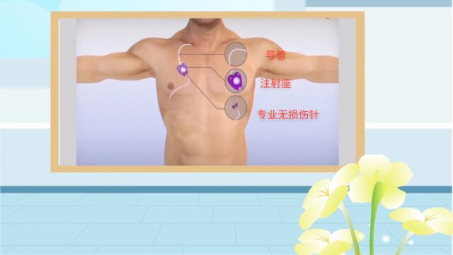 医学科普:输液港那些事,你知道么?