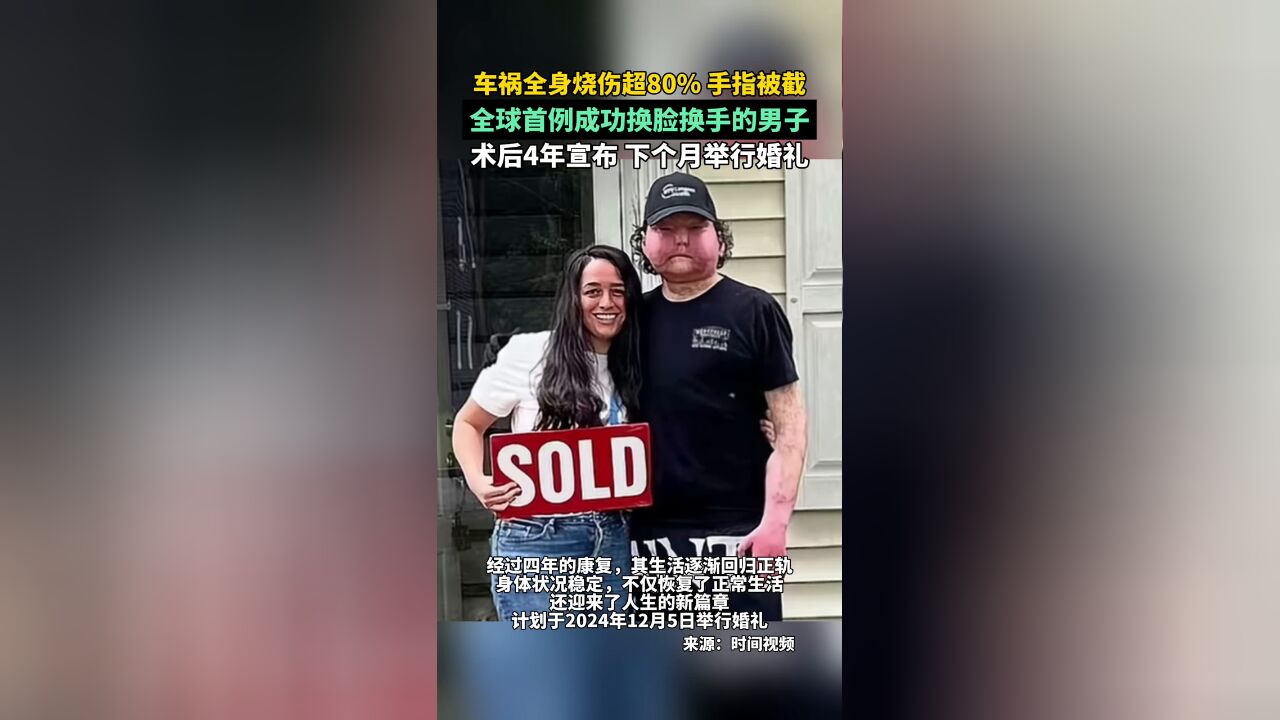 车祸全身烧伤超80%,全球首例成功换脸换手男子术后4年结婚