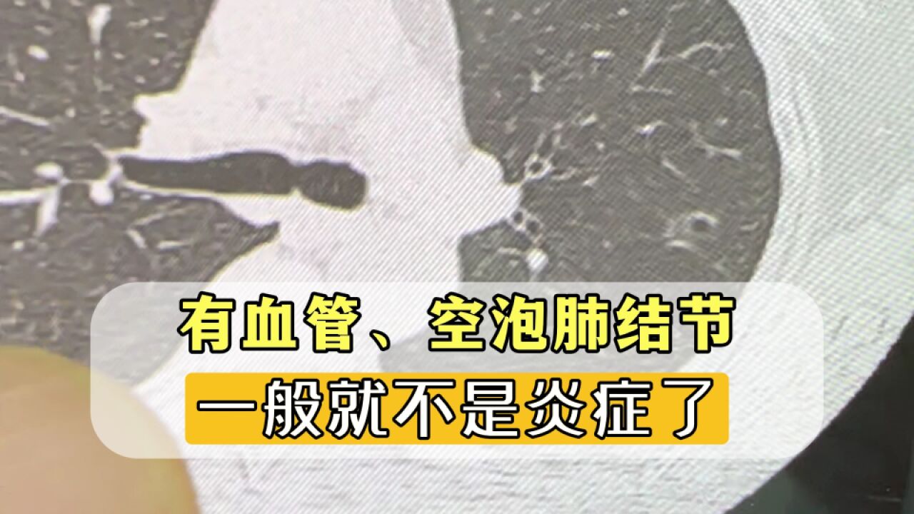 教您看肺CT片!这种有血管、空泡的结节,一般就不是炎症了