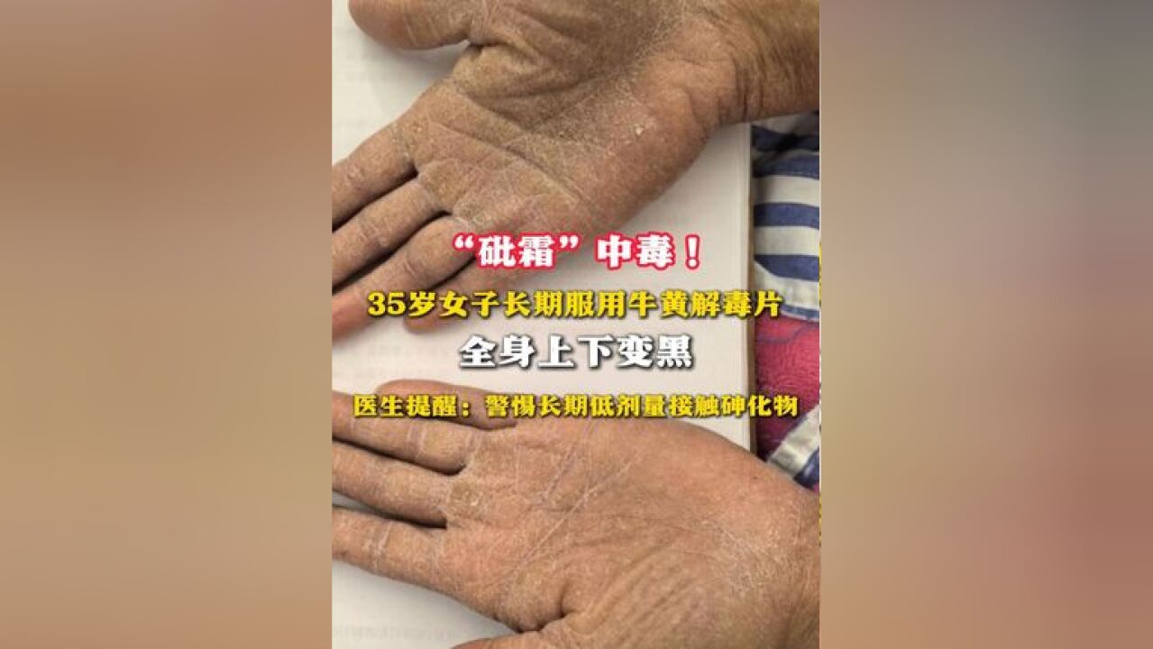 “砒霜”中毒!35岁女子长期服用牛黄解毒片 全身上下变黑 医生提醒:警惕长期低剂量接触砷化物