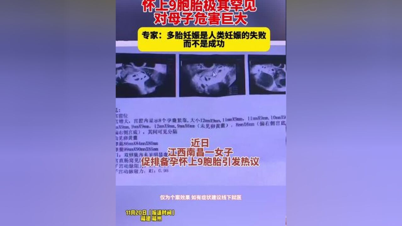 怀上9胞胎极其罕见 对母子危害巨大 专家:多胎妊娠是人类妊娠的失败 而不是成功