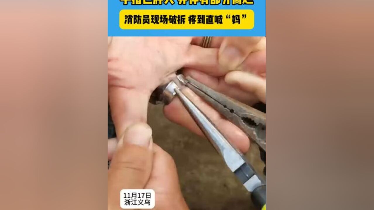 阿婆戒指常带不取“长”进肉里 手指已肿大 并伴有部分腐烂#意不意外