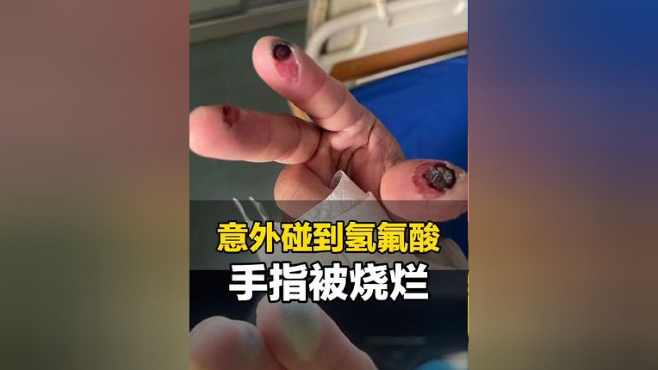 福建泉州一名男子工作时意外沾到氢氟酸,三根手指被灼烧出黑洞,严重的话要刮骨截肢