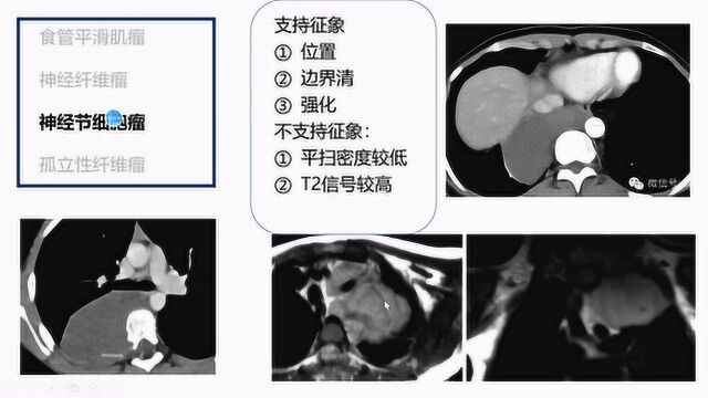 20期胸部病理回顾浙大二院放射科