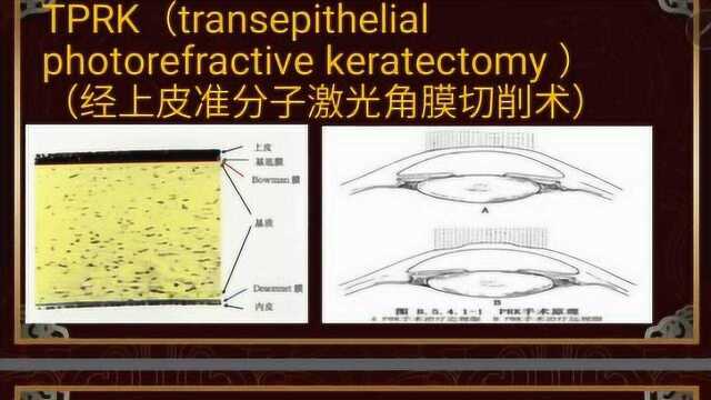 近视屈光手术概述2tprk1讲