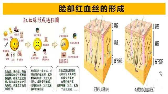 脸部红血丝是怎么回事?主要是5个原因导致的,了解一下详情吧