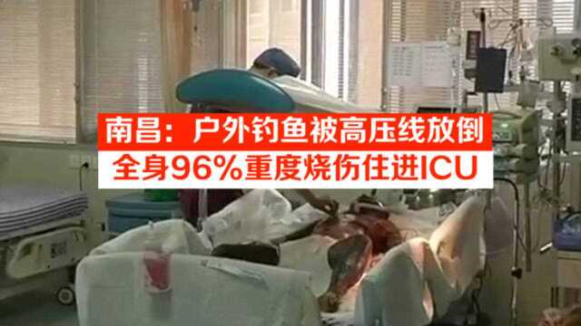 南昌:户外钓鱼被高压线放倒,全身96%重度烧伤住进ICU