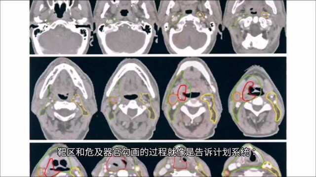 什么是靶区勾画