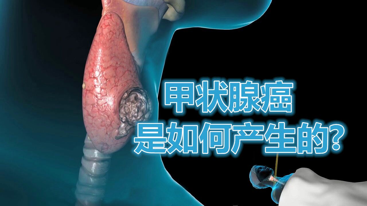 甲状腺癌是如何产生的 如何预防甲状腺癌