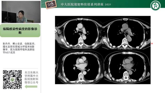 纵隔感染性病变影像诊断分析中大彭丹丹