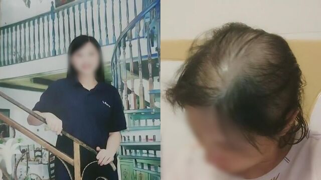 32岁女子10年剖腹产3次生3胎,头发几乎掉光了,低头后网友太心疼