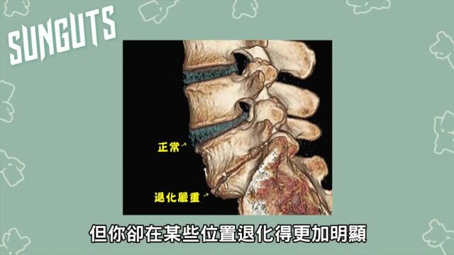 骨刺其实不是刺! 治骨刺的神药是什么?