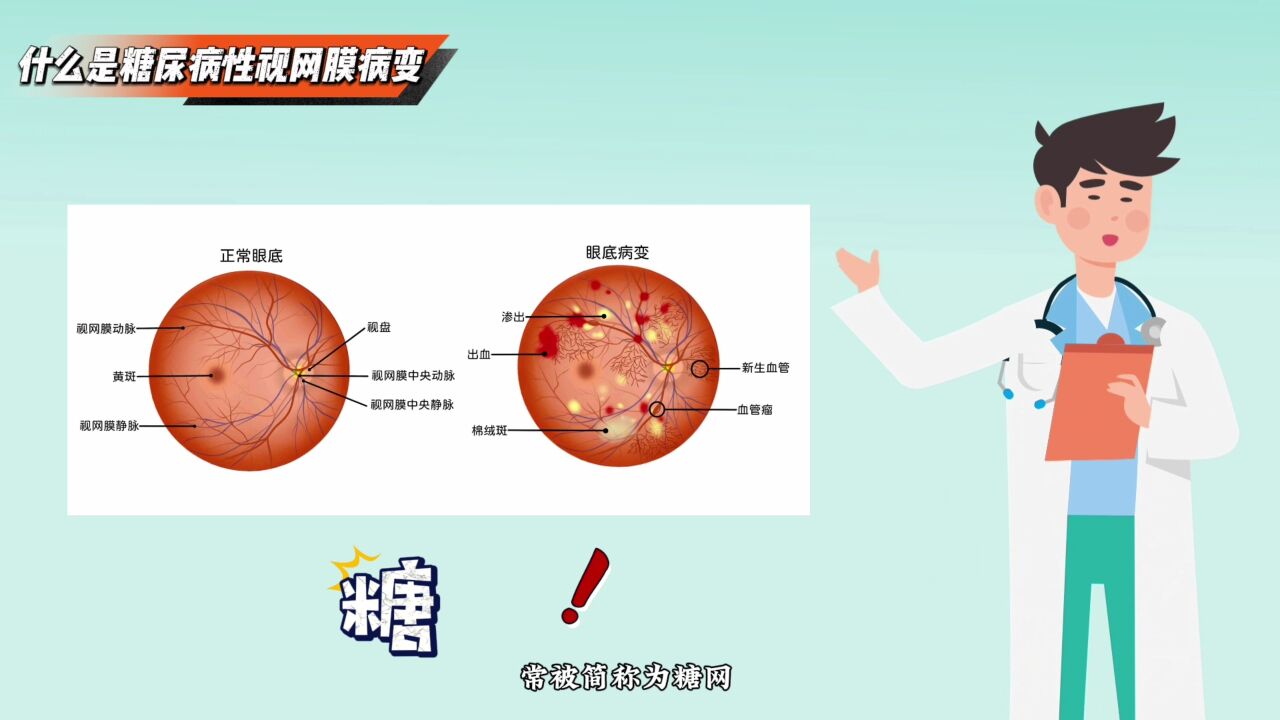 不怕糖甜,就怕“糖网”蒙住眼!小心这个“甜蜜的视力杀手”