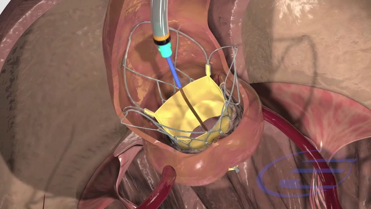 印度医疗器械崛起了?Hydra新型介入瓣膜治疗瓣膜狭窄
