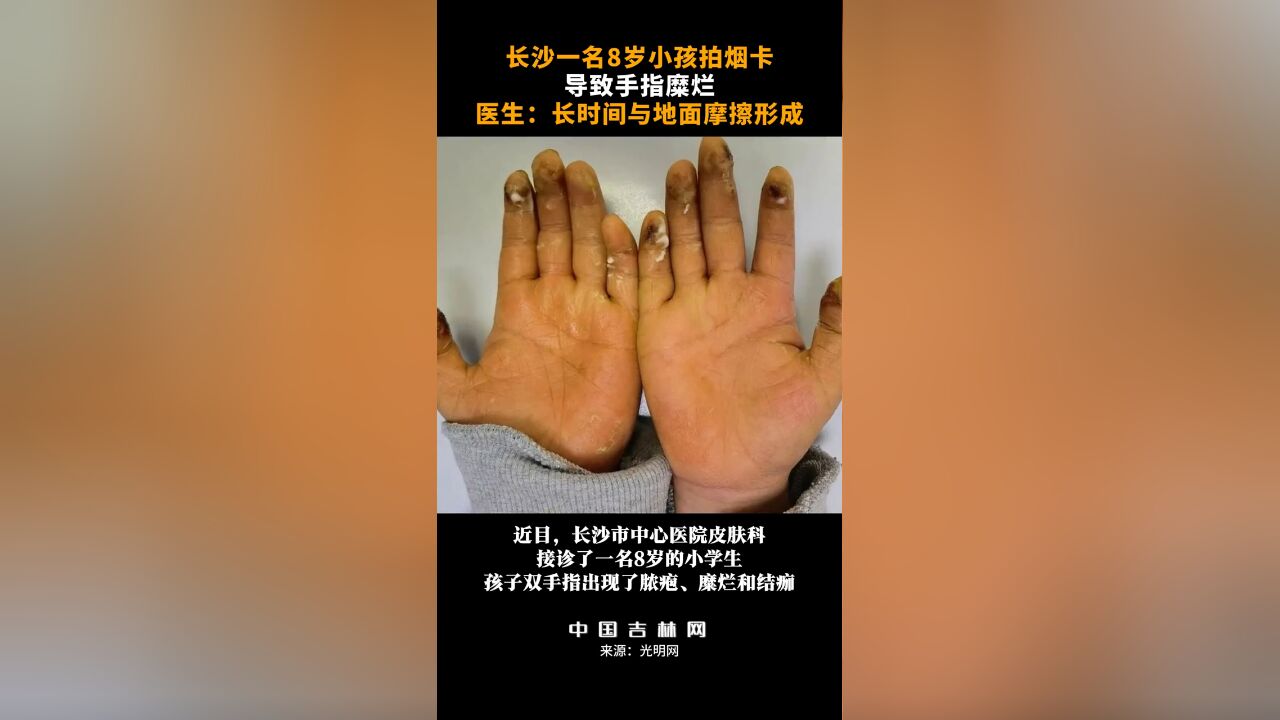 8岁小孩拍烟卡导致手指糜烂,医生:长时间与地面摩擦形成