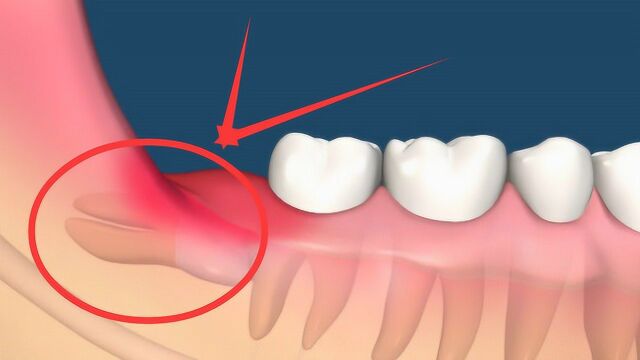 每个人都会长智齿吗?智齿要不要留?今天终于知道了