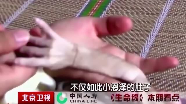 生命缘:小恩泽的四肢严重萎缩毫无血色!肚子涨得像个皮球!