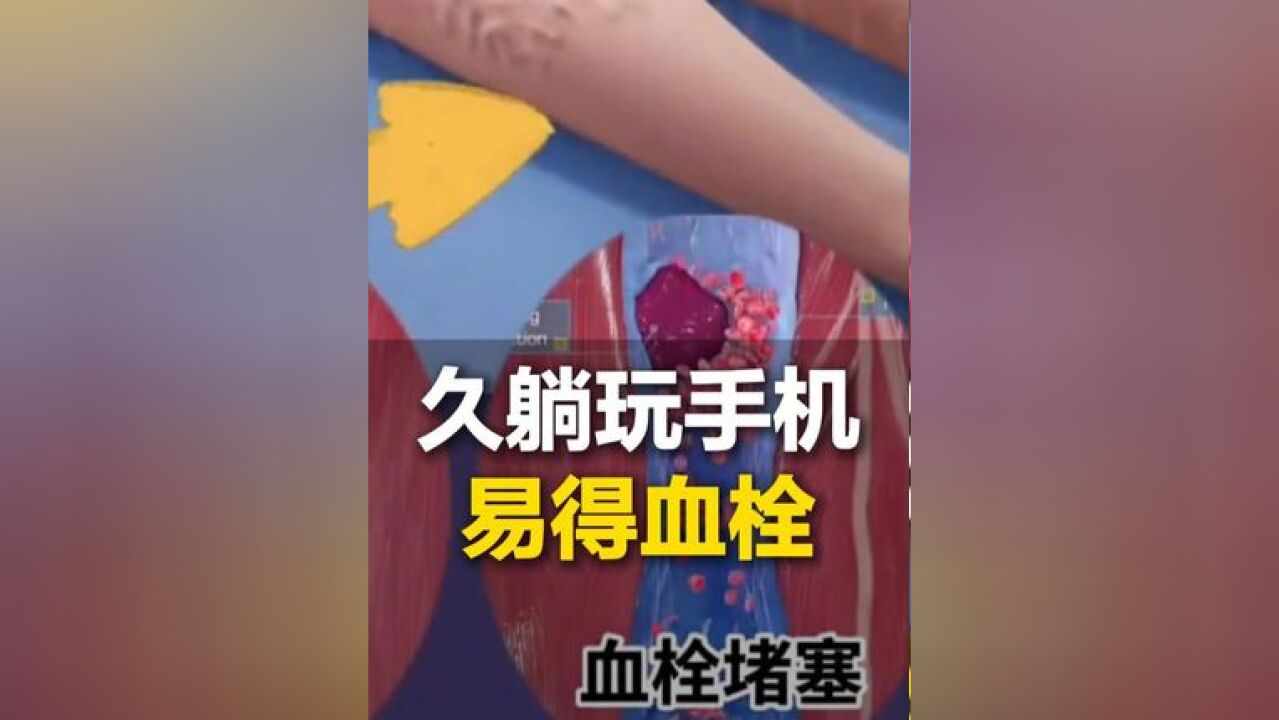 长时间躺在床上玩手机等不良习惯会让年轻人也患有血栓,专家建议久卧久坐之后要适当运动