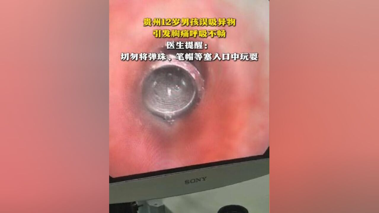 贵州12岁男孩误吸异物 引发胸痛呼吸不畅 医生提醒:切勿将弹珠、笔帽等塞入口中玩耍