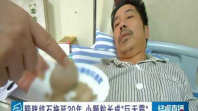 膀胱结石拖延20年 小颗粒长成巨无霸