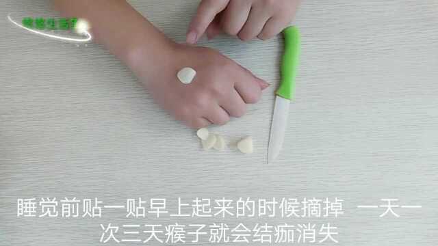 脸上脖子上长瘊子很难看,教你一个小方法,3天消失不留痕