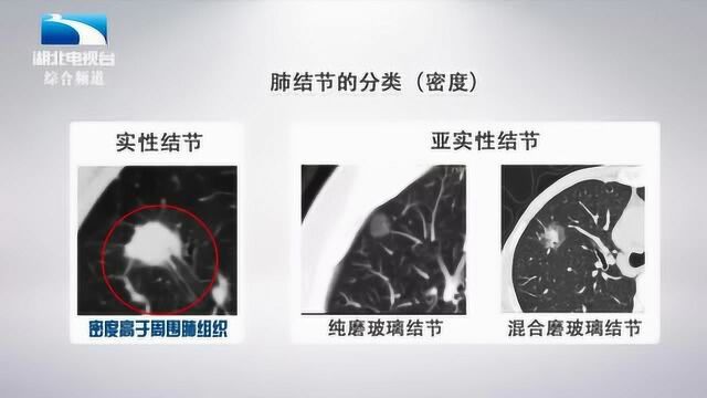 肺结节类型不同风险不同?纯磨玻璃结节多数是肺炎,可观察!