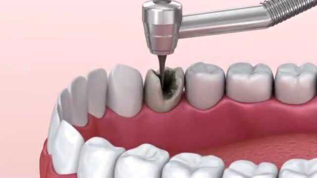 发黑的牙齿要及时修补,坏到压根就需要治疗,3D动画演示整个过程!