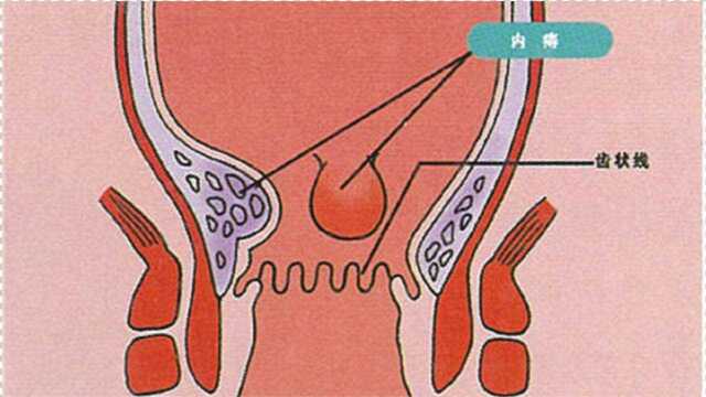 得了痔疮需要注意哪些方面?该怎么样去治疗呢?