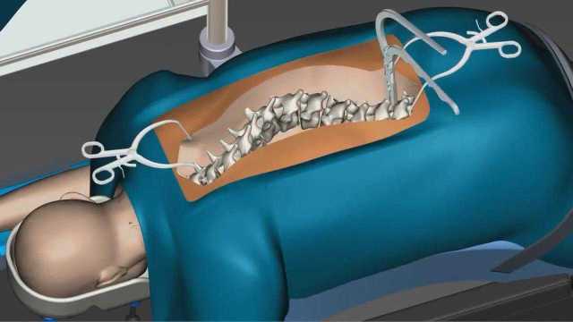 脊椎弯曲手术是怎么做的?3D动画演示出来后,越想越可怕!