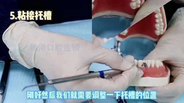 深圳牙齿矫正科普—粘托槽的材料和过程是怎样的呢?