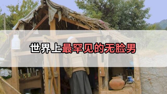 世界上超罕见的人,生活在现实中的无脸男,曾被人当野兽攻击