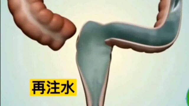 你体验过这样的灌肠吗?好奇是什么滋味!